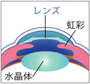 前房型有水晶体眼内レンズ