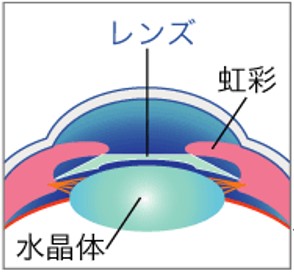 後房型有水晶体眼内レンズ